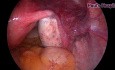 Cannulation for Tubal Block by Use of Hysteroscopy