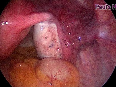 Cannulation for Tubal Block by Use of Hysteroscopy