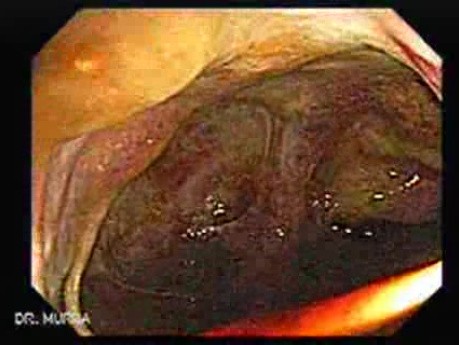 Severe case of Ischemic Colitis (2 of 19)