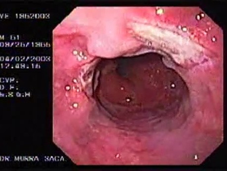 Banding of esophageal varices (15 of 17)