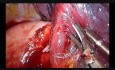 Uniportal VATS Left Apico-posterior Anatomic Segmentectomy (S1-2)