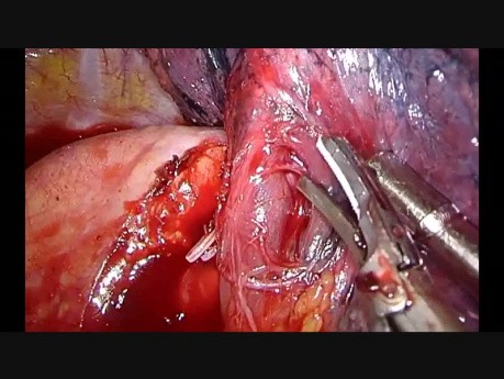 Uniportal VATS Left Apico-posterior Anatomic Segmentectomy (S1-2)