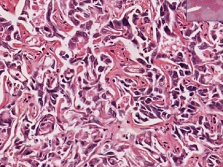 Cholangiocarcinoma, moderately well di - Histopathology - Liver