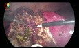 Gallbladder Tear During Lap Cholecystectomy