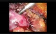 Laparoscopic Partial Nephrectomy - Nephron-Sparing Surgery