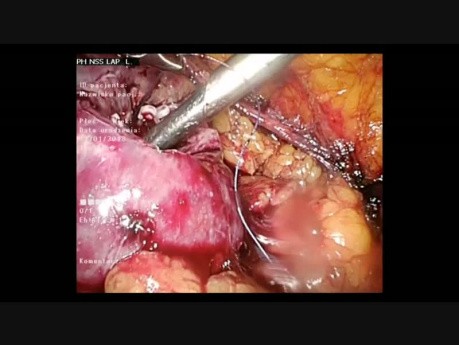 Laparoscopic Partial Nephrectomy - Nephron-Sparing Surgery