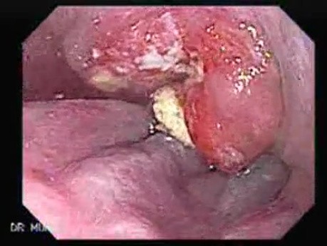 Esophageal Squamous Cell Carcinoma (1 of 2)