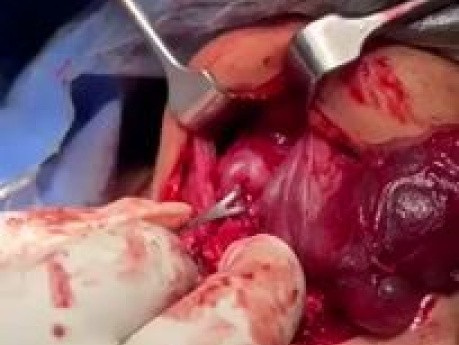 Ligate the Superior Thyroid Vessels Near the Upper Pole of the Gland to Avoid Injury of the external Laryngeal Nerve