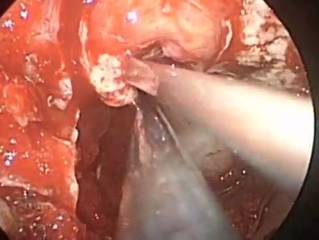 Transsphenoideal Removal of Pituitary Tumor
