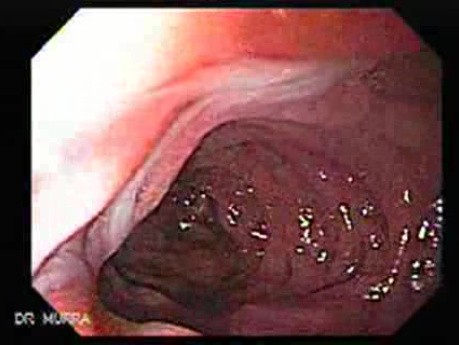 Larynx with Jaundice (3 of 6)