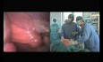 Laparoscopic Abdominal Hernia Repair with SILS® port – part 2