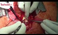 Using TachoSil® for Sealing Anastomoses During Cardiac Revascularisation Surgeries, Wojciech Stachowiak