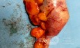 Laparoscopic Appendiceal Neoplasm Removal