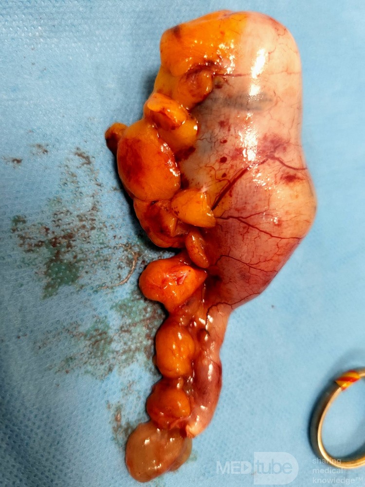 Laparoscopic Appendiceal Neoplasm Removal