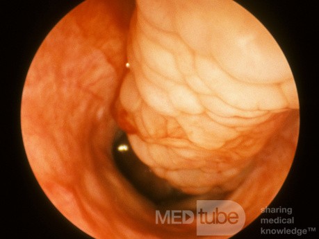 Sarcoidosis Inferior Turbinate