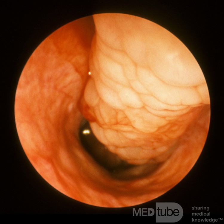 Sarcoidosis Inferior Turbinate