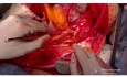 Thoracoabdominal Aortic Aneurysm and Replacement with Branched Tubular Graft