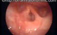 The Larynx (Voicebox) - The Absence of The Epiglottis (Lid)