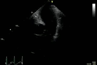 Pulmonary Trunk Thrombus