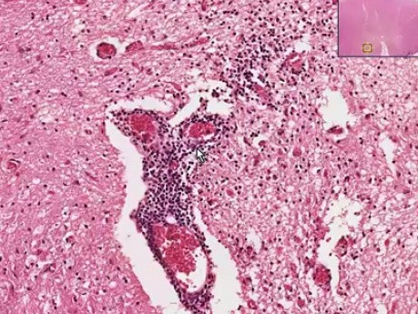 Poliomyelitis - Histopathology of skeletal muscle, spinal cord