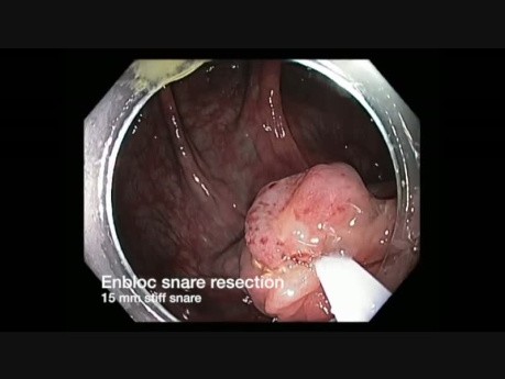 Colonoscopy Channel - Colon EMR Channel