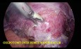 Total Laparoscopic Hysterectomy - Fibroid Uterus