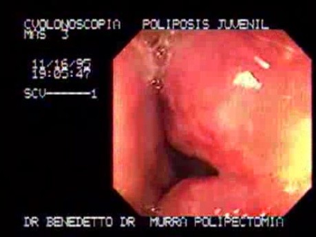 Non Familial Juvenile Polyposis Of The Colon (2 of 37)