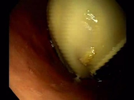 Endoscopic Balloon Removal (1 of 9)