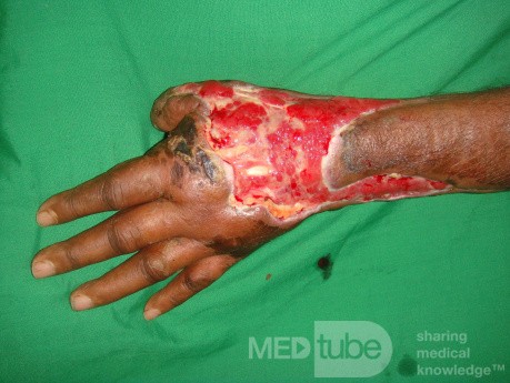 Diabetic hand