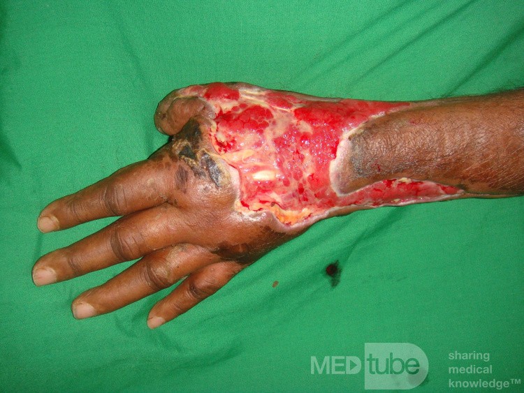 Diabetic hand