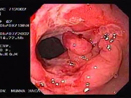 Crohn´s Disease (15 of 28)