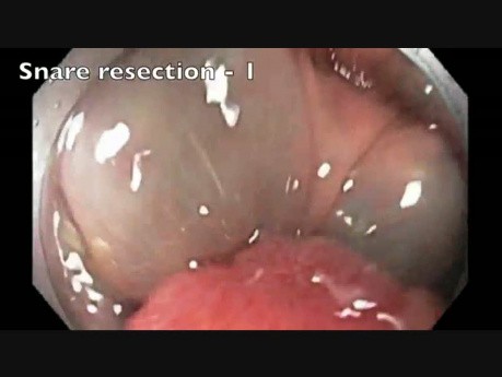 Colonoscopy - Ascending Colon-Flat Lesion-EMR-Microperforation Closure
