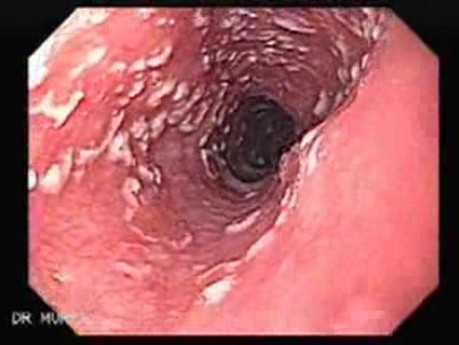Candidiasis - White Spots in the Esophagus