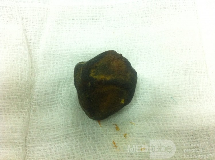Gallstone Ileus