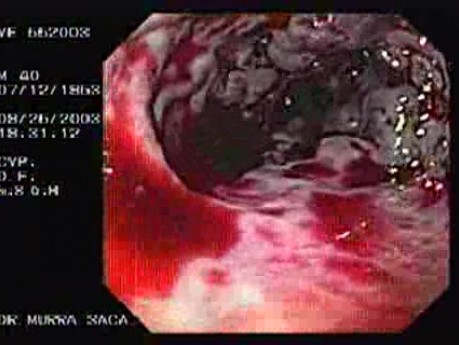 Acute Variceal Bleeding - Visualization of Bleeding