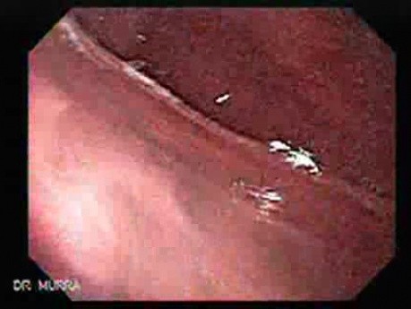 Early Gastric Cancer of the Gastroesophageal Junction - 83-Years Old Male
