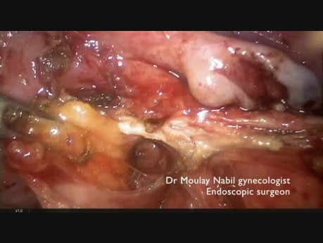 Utero Sacral Endometriosic Nodule Resection