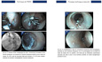 Peroral Endoscopic Myotomy (POEM)