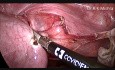 Total Laparoscopic Hysterectomy and Cholecystectomy in Same Patient