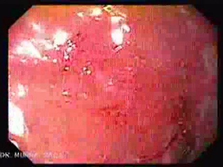 Erosions Of The Duodenum - Gastroduodenoscopy