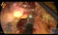 Lap Right Colectomy with D2 Lymphadenectomy, Artisential