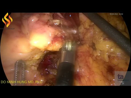 Lap Right Colectomy with D2 Lymphadenectomy, Artisential