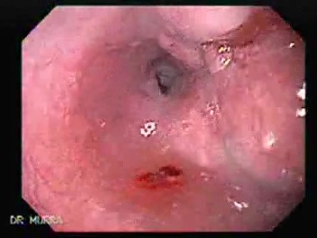 Esophageal Squamous Cell Carcinoma (3 of 3 )