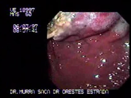 Adenocarcinoma of the Gastric Fundus