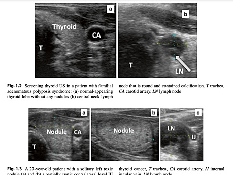 Controversies in Thyroid Surgery