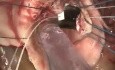 Operative Technique of Aortic Valve Replacement (2)