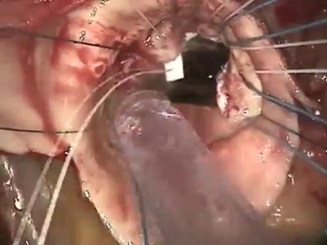Operative Technique of Aortic Valve Replacement (2)