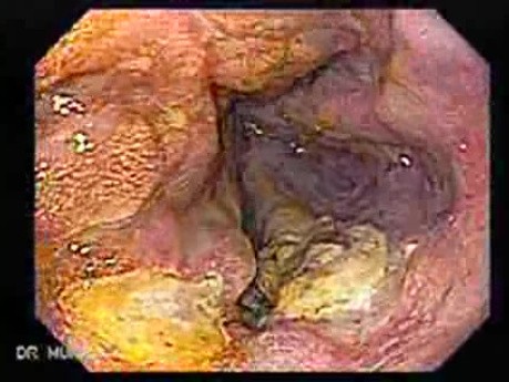 Long Standing Alcohol Abuse - Status Post Banding