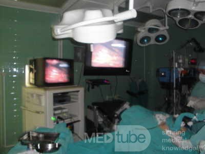 Gastric Ulcerated Adenocarcinoma of the Pre-pyloric Antrum (5 of 28)