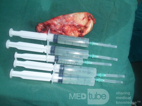 Acute cholecystitis removed by Lap chole